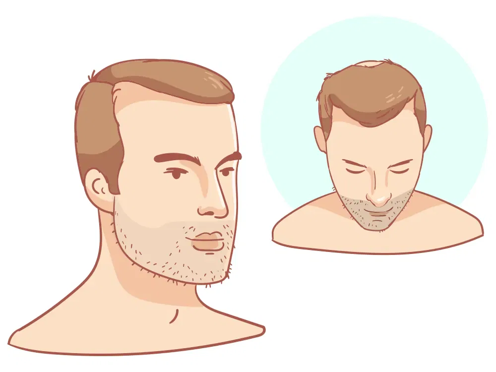 Отступающая линия волос + небольшая коронка